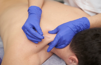 Acupuncture Dry Needling