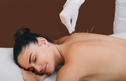 Acupuncture Dry Needling