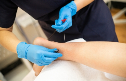 Acupuncture Dry Needling