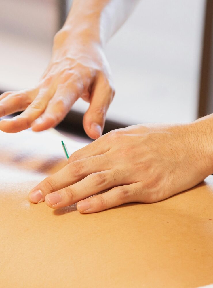 Acupuncture Dry Needling