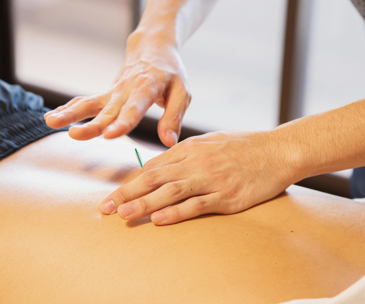 Acupuncture Dry Needling
