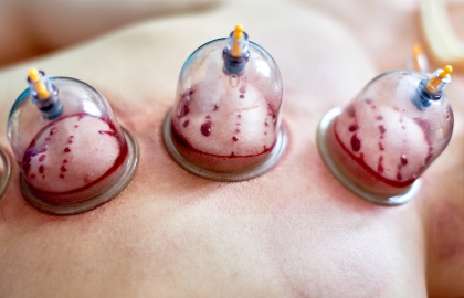 Cupping Therapy