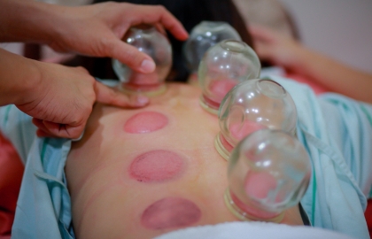 Cupping Therapy