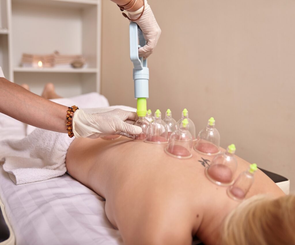 Cupping Therapy